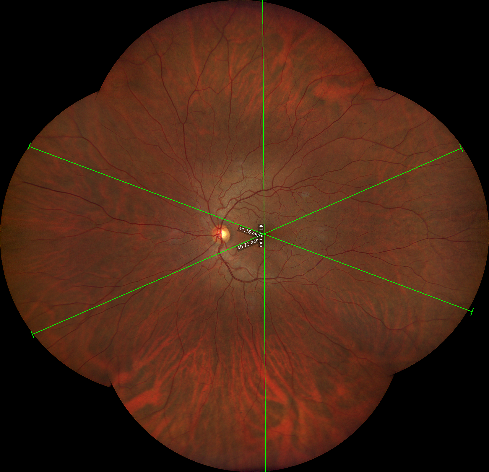 Imaging Wide Fielde e Ultra Wide Field con Clarus 500 Zeiss